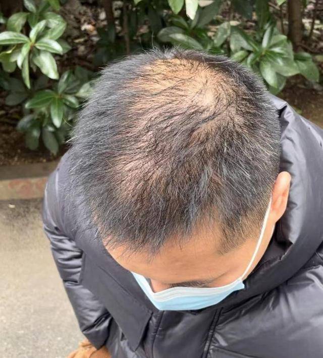 “还能反光<strong></p>
<p>桔子币</strong>！”长沙男子植发近9月称后脑勺“像狗啃过”