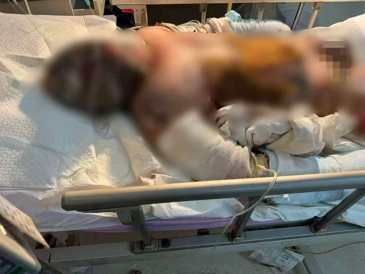 父子在哈尔滨一亲戚公司上班遇爆炸全身烧伤<strong></p>
<p>DAI</strong>,治疗花费近百万公司拒赔偿?亲戚回应