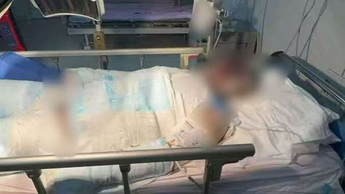 父子在哈尔滨一亲戚公司上班遇爆炸全身烧伤<strong></p>
<p>DAI</strong>,治疗花费近百万公司拒赔偿?亲戚回应